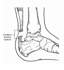 Achilles Tendon Rupture Foot Drawing