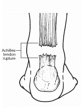 Achilles Tendon Rupture Rear Foot Drawing