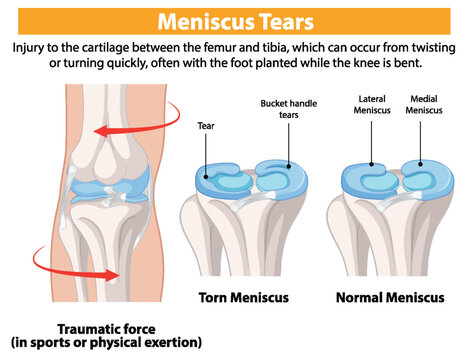 Diagram of meniscus tears showing a knee joint with torn meniscus (tear and bucket-handle tear) compared to a normal meniscus (lateral and medial). Text explains that meniscus tears occur from twisting or turning forces, often during physical activity with the foot planted